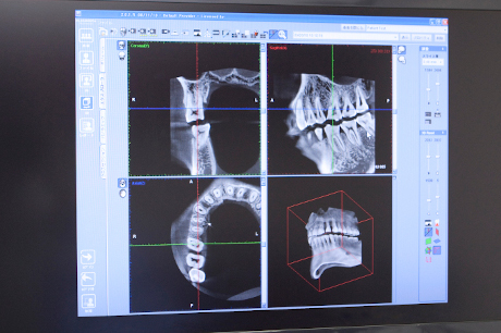歯科用CTを用いた「安心」への取り組み