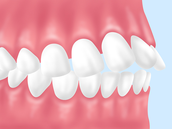 上顎前突（じょうがくぜんとつ）