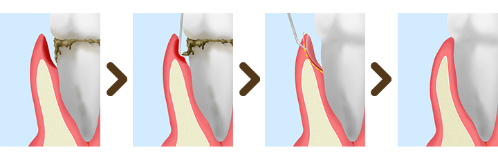 歯周ポケット掻把（そうは）術