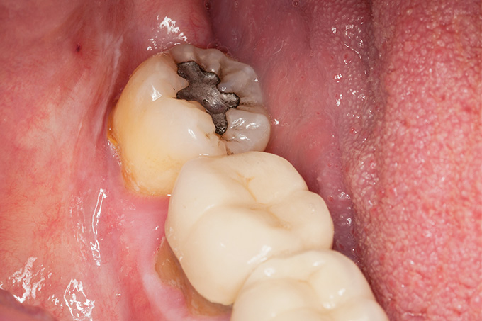 30件中29件が再治療患者。修理した歯は脆くなってしまうもの