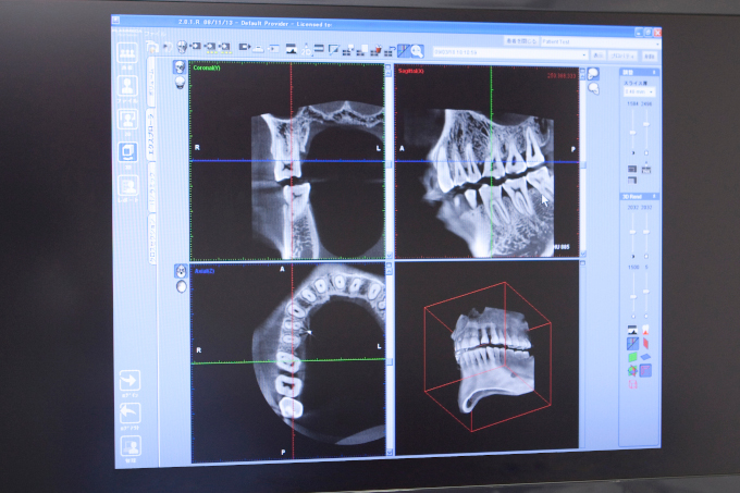 問題箇所を三次元的に把握する歯科用CT