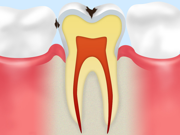 C1　エナメル質の虫歯