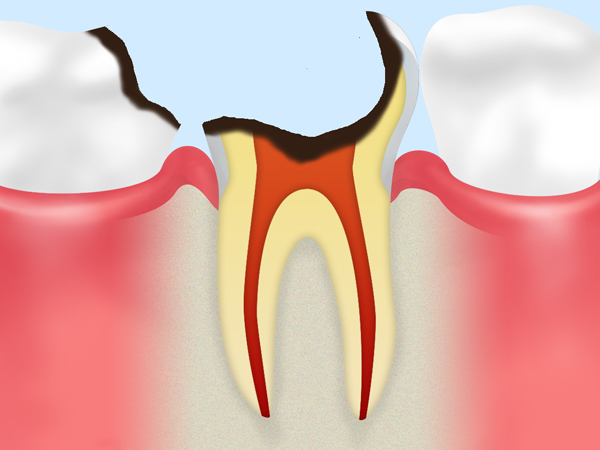 C4　末期の虫歯